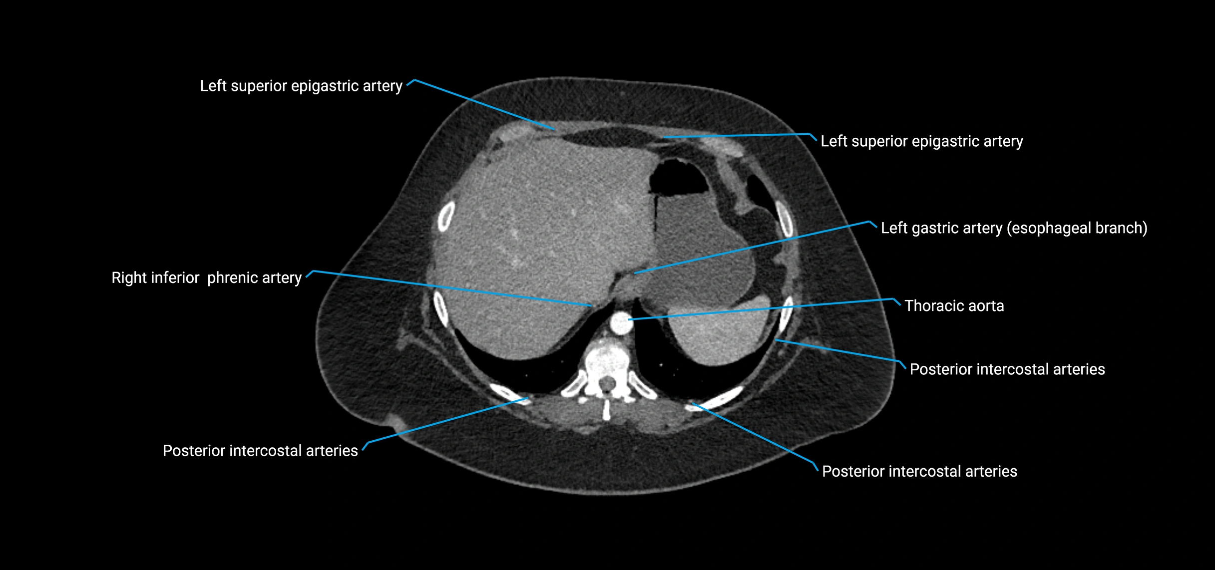 CTA abdomen axial cross sectional anatomy labelled image_28 (3).webp